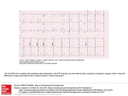 On this ECG from a patient with wandering atrial pacemaker, the R–R intervals vary from beat to beat, creating an irregularly irregular rhythm. Note the.