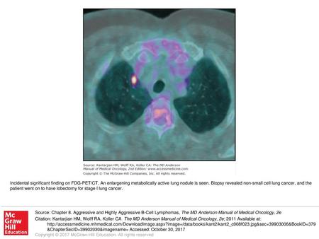 Incidental significant finding on FDG-PET/CT
