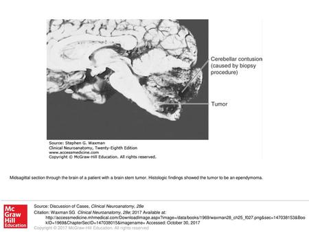 Midsagittal section through the brain of a patient with a brain stem tumor. Histologic findings showed the tumor to be an ependymoma. Source: Discussion.