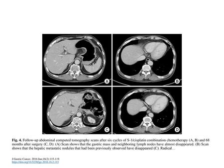 Fig. 4. Follow-up abdominal computed tomography scans after six cycles of S-1/cisplatin combination chemotherapy (A, B) and 68 months after surgery (C,