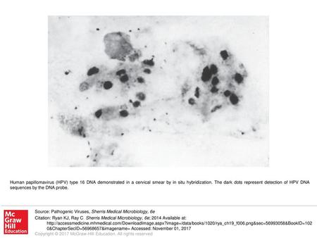 Human papillomavirus (HPV) type 16 DNA demonstrated in a cervical smear by in situ hybridization. The dark dots represent detection of HPV DNA sequences.