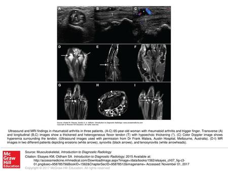 Ultrasound and MRI findings in rheumatoid arthritis in three patients