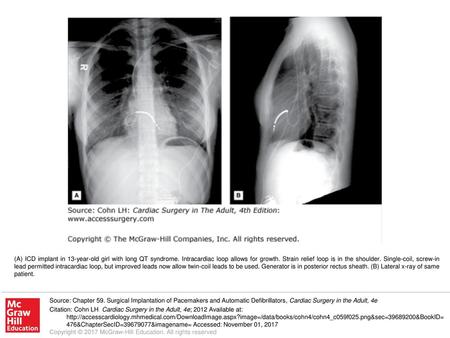 (A) ICD implant in 13-year-old girl with long QT syndrome