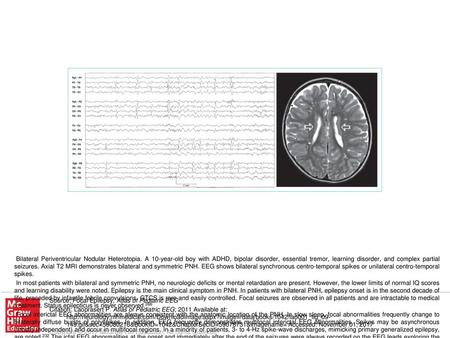 A close relationship exists between heterotopic nodules and cortical regions in bilateral PNH, with an epileptogenic network including both structures.