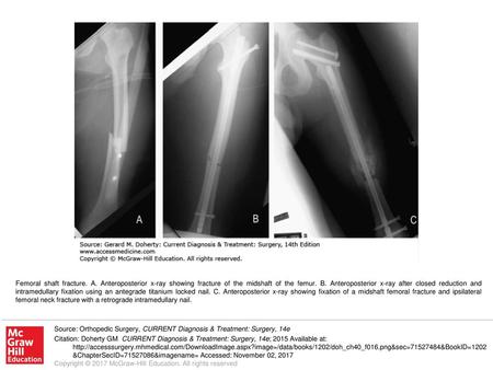 Femoral shaft fracture. A