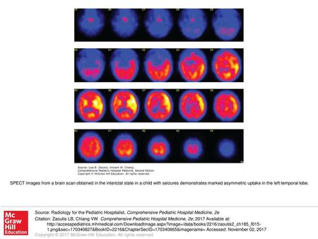 SPECT images from a brain scan obtained in the interictal state in a child with seizures demonstrates marked asymmetric uptake in the left temporal lobe.