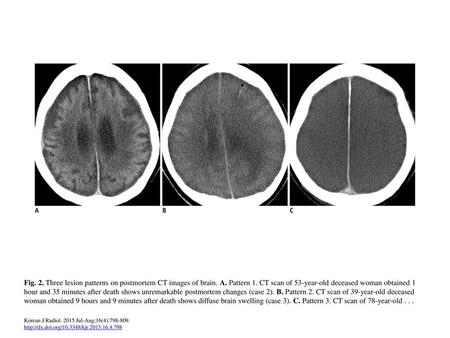 Fig. 2. Three lesion patterns on postmortem CT images of brain. A
