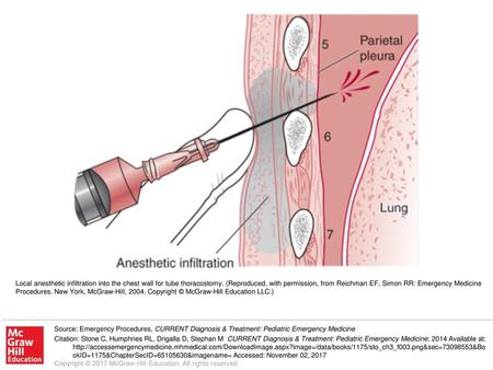 Local anesthetic infiltration into the chest wall for tube thoracostomy. (Reproduced, with permission, from Reichman EF, Simon RR: Emergency Medicine Procedures.