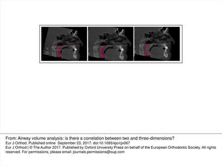 Figure 2. Illustration of minimum cross-sectional area (a) and measurements for oropharynx and soft palate in sagittal plane (b, c). From: Airway volume.