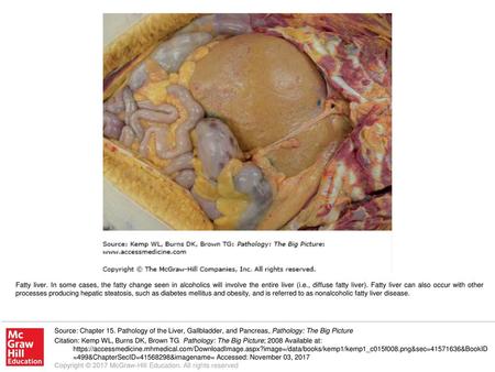Fatty liver. In some cases, the fatty change seen in alcoholics will involve the entire liver (i.e., diffuse fatty liver). Fatty liver can also occur with.