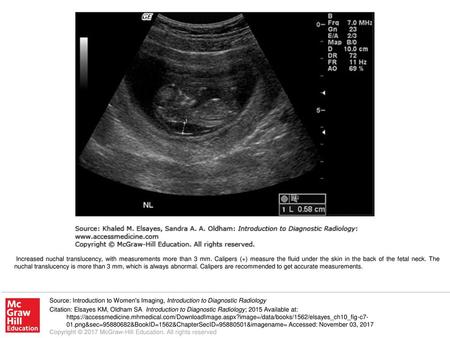 Increased nuchal translucency, with measurements more than 3 mm