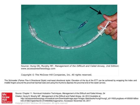 The Schroeder (Parker Flex-It Directional Stylet) oral/nasal directional stylet. Elevation of the tip of the ETT can be achieved by wrapping the index.