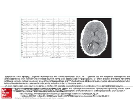 Epilepsy is an important predictor of poor intellectual outcome in the children with hydrocephalus with shunts. Epilepsy was significantly affected by.