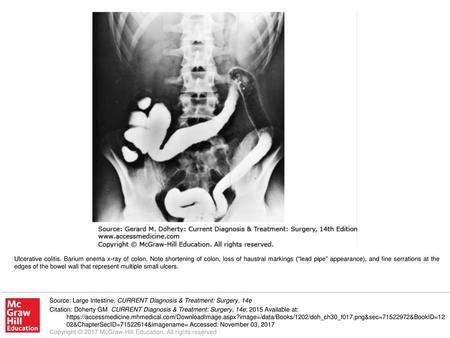 Ulcerative colitis. Barium enema x-ray of colon