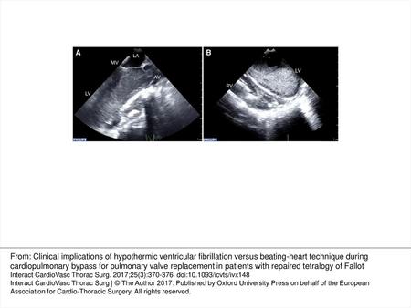 Figure 1 Representative transoesophageal echocardiographic images of ventricular fibrillation during cardiopulmonary bypass. (A) Mid-oesophageal aortic.