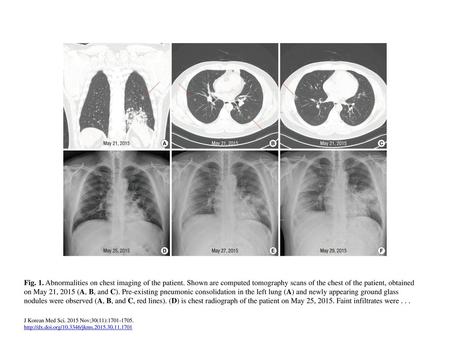 Fig. 1. Abnormalities on chest imaging of the patient