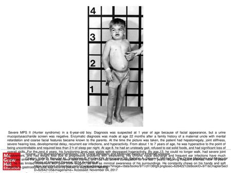 Severe MPS II (Hunter syndrome) in a 6-year-old boy