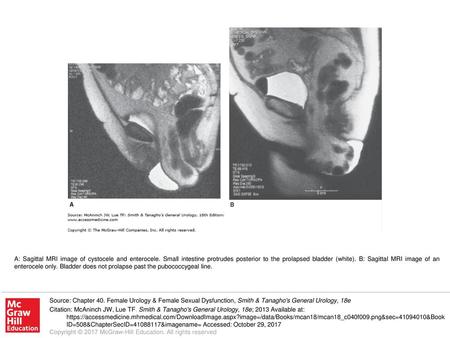 A: Sagittal MRI image of cystocele and enterocele