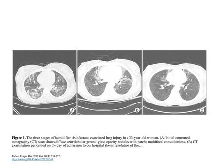 Figure 1. The three stages of humidifier disinfectant-associated lung injury in a 33-year-old woman. (A) Initial computed tomography (CT) scan shows diffuse.