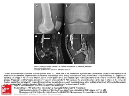 Indirect and direct signs of anterior cruciate ligament tears