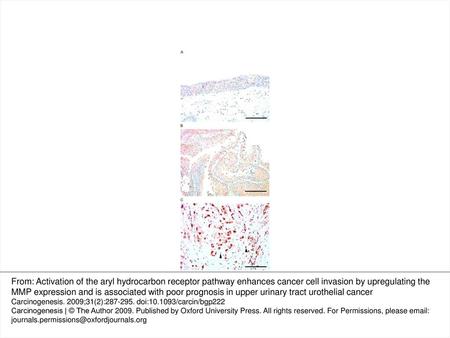 Fig. 1. Immunostaining for AhR in non-neoplastic urothelium ( A ), superficial UC ( B ) and invasive UC ( C ). ( A ) Weak cytoplasmic staining in the.