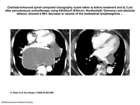 Contrast-enhanced spiral computed tomography scans taken a) before treatment and b) 3 yrs after percutaneous sclerotherapy using Ethibloc® (Ethicon, Norderstedt,