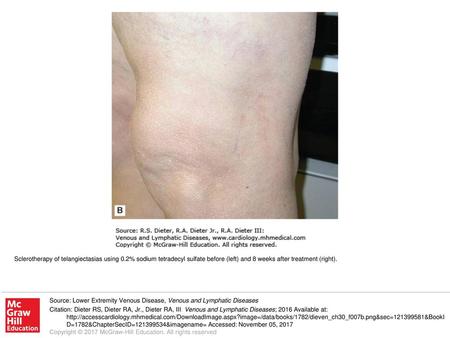 Sclerotherapy of telangiectasias using 0