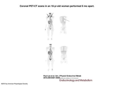 Coronal PET-CT scans in an 18-yr-old woman performed 6 mo apart.