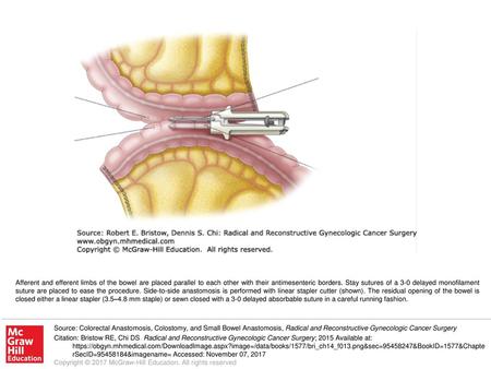 Afferent and efferent limbs of the bowel are placed parallel to each other with their antimesenteric borders. Stay sutures of a 3-0 delayed monofilament.