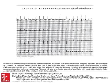 (A) 12-lead ECG demonstrating atrial flutter with variable conduction in a 10-day-old infant who presented to the emergency department with poor feeding.