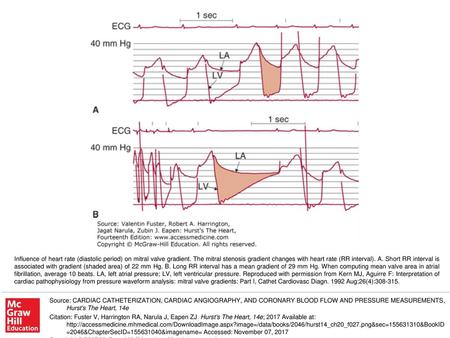 Influence of heart rate (diastolic period) on mitral valve gradient