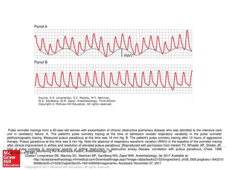 Pulse oximeter tracings from a 60-year-old woman with exacerbation of chronic obstructive pulmonary disease who was admitted to the intensive care unit.
