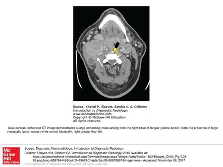 Axial contrast-enhanced CT image demonstrates a large enhancing mass arising from the right base of tongue (yellow arrow). Note the presence of large metastatic.