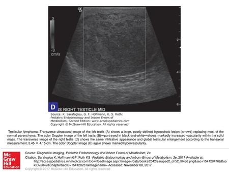 Testicular lymphoma. Transverse ultrasound image of the left testis (A) shows a large, poorly defined hypoechoic lesion (arrows) replacing most of the.