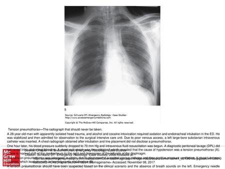 A tension pneumothorax should have been suspected based on the clinical scenario and the absence of breath sounds on the left. Emergency needle decompression.