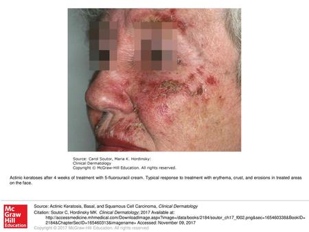 Actinic keratoses after 4 weeks of treatment with 5-fluorouracil cream
