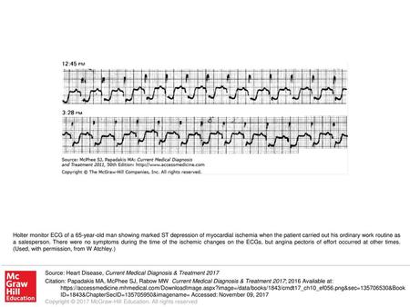 Holter monitor ECG of a 65-year-old man showing marked ST depression of myocardial ischemia when the patient carried out his ordinary work routine as a.