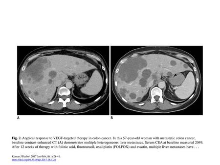 Fig. 2. Atypical response to VEGF-targeted therapy in colon cancer