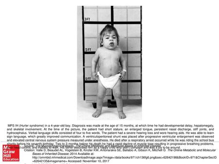 MPS IH (Hurler syndrome) in a 4-year-old boy