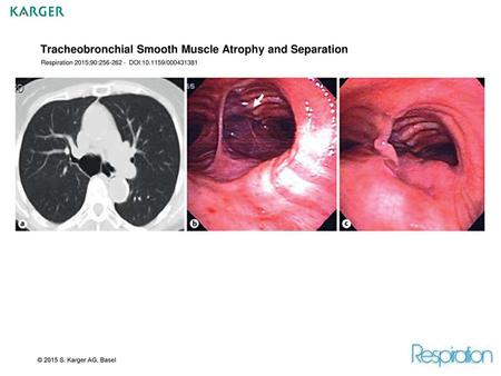 Tracheobronchial Smooth Muscle Atrophy and Separation