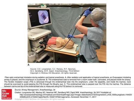 Fiber-optic orotracheal intubation during sedation and topical anesthesia. A. After sedation and application of topical anesthesia, an Ovassapian intubating.