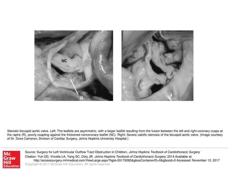 Stenotic bicuspid aortic valve