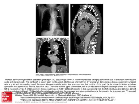 Thoracic aortic aneurysm status post stent-graft repair