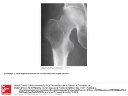 Radiograph of a solitary plasmacytoma in the proximal femur of a 46-year-old man. Source: Chapter 5. Musculoskeletal Oncology, Current Diagnosis & Treatment.