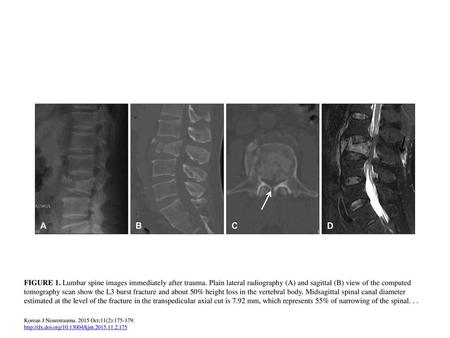 FIGURE 1. Lumbar spine images immediately after trauma
