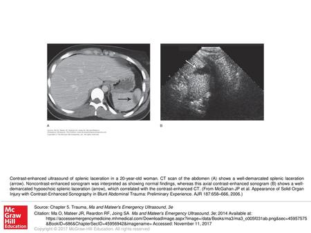 Contrast-enhanced ultrasound of splenic laceration in a 20-year-old woman. CT scan of the abdomen (A) shows a well-demarcated splenic laceration (arrow).