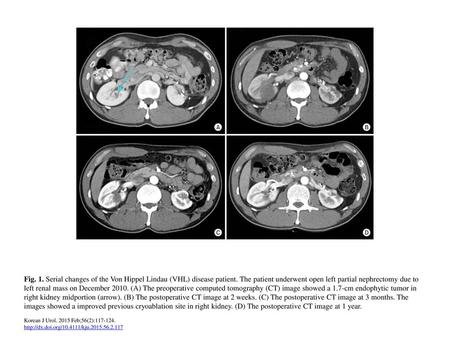 Fig. 1. Serial changes of the Von Hippel Lindau (VHL) disease patient