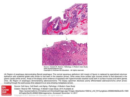 (A) Region of esophagus demonstrating Barrett esophagus: The normal squamous epithelium (left margin of figure) is replaced by specialized columnar epithelium.