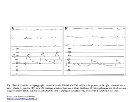 Fig. 2.Baseline and the event polygraphic records show the 3 limb leads ECG and the pulse pressure at the right common femoral artery sheath. A: baseline.