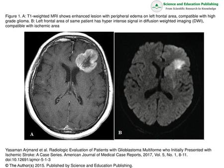 Figure 1. A: T1-weighted MRI shows enhanced lesion with peripheral edema on left frontal area, compatible with high grade glioma. B: Left frontal area.